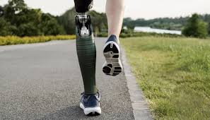 Modern Prosthetics: Technology, Transformation, and the New Quality of Life